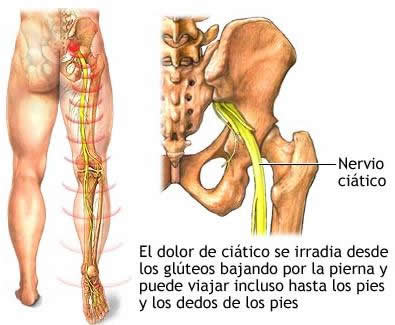 La quiropráctica tiene solución para la ciatica