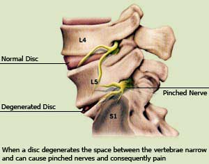 Quiropractica y Artrosis