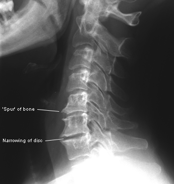 X Ray of Degenerated Spine