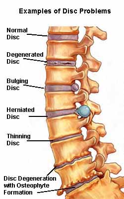 Spinal Degeneration