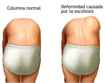 escoliosis - un peligro para tus niños hasta que llegue a su madurez