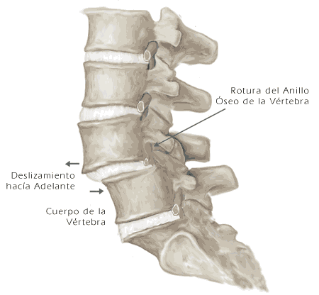 La quiropráctica tiene solución para la Espondilolistesis