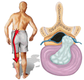 Causas de Hernia de Disco