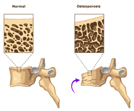 osteoporosis no se debe a una falta de calcio en la dieta mediteranea