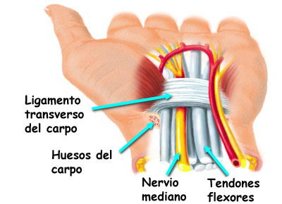 El síndrome del túnel carpiano tiene muy buenos resultados con la Quiropráctica, y por no pasar por quirófano, no hay riesgos.